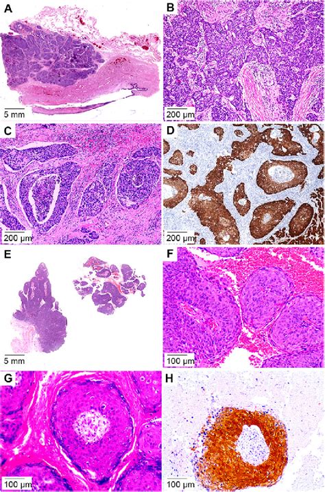 Basaloid Squamous Cell Carcinoma And Papillary Basaloid Variant A