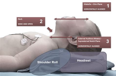 Neonatal Resuscitation Emergency Medicine Cases Em Cases