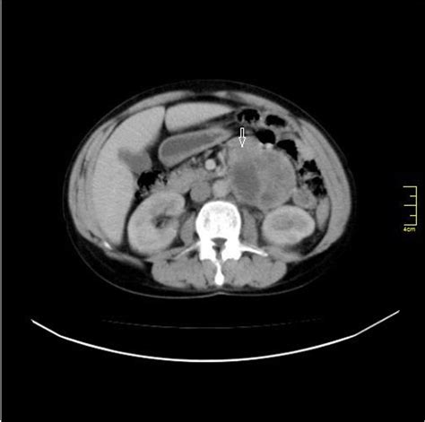 Axial Abdomen Ct With I V Contrast Shows 9 × 73 × 65 Cm Well