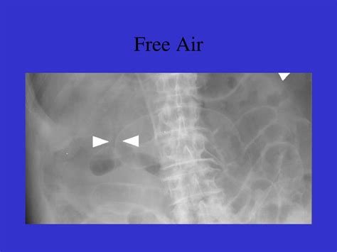 Ppt Abdominal X Ray Powerpoint Presentation Free Download Id2983195