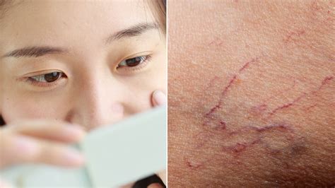 How To Treat And Prevent Broken Capillaries On Your Face Allure