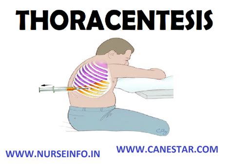 Thoracentesis Nurse Info