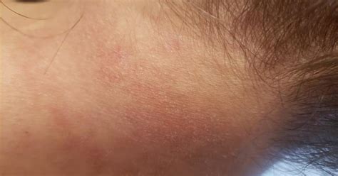 Lupus Skin Rash On Neck
