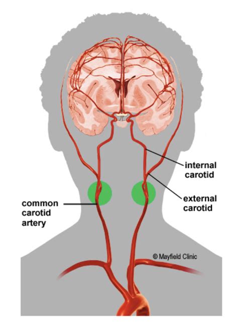 They originate from the carotid bifurcation, travel through the. Carotid Artery Stenosis | Hope For Hearts Australia