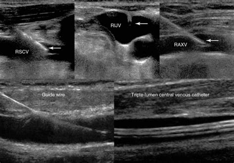 Ultrasound Guided Vascular Access Trends And Perspectives Radiology Key