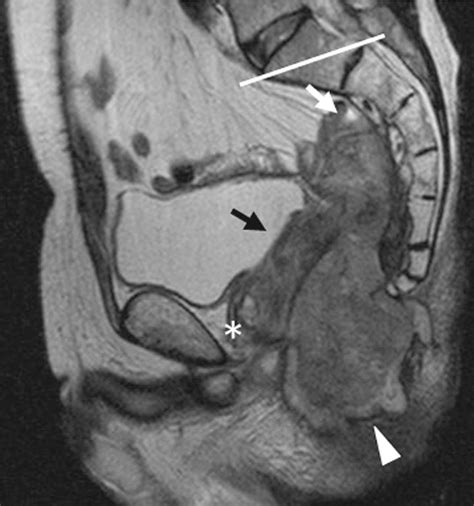 Figure 1 From Total Pelvic Exenteration With Sacrectomy For Re