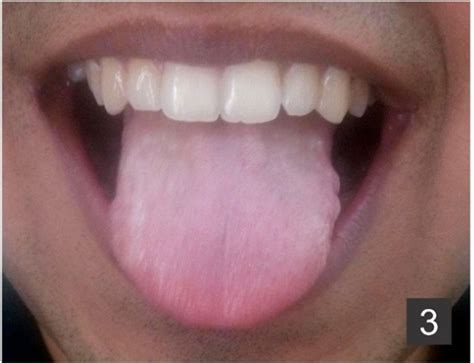 Figure 3 Complete Resolution Of Black Hairy Tongue After Withdrawal Of