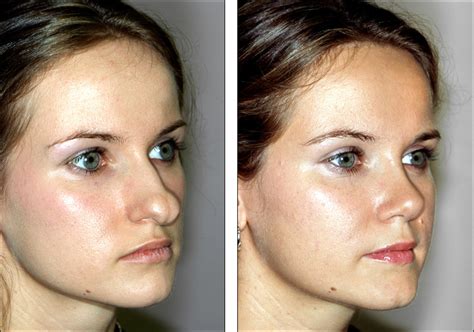 Dr Steven Denenbergs Facial Plastic Surgery Before And Afters