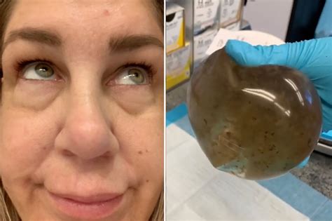 Mold In Womans Breast Implant Came Close To Killing Her