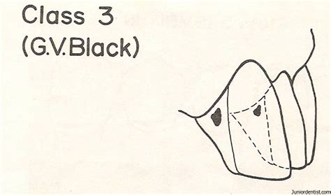 Dental Caries Gv Black Classification Of Carious Lesions