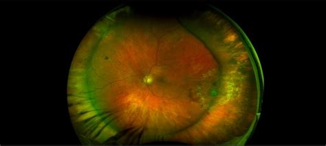 Uwf Of Retinal Detachment Corrected With Scleral Buckle Retina Image Bank