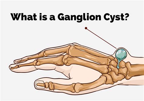What Causes A Ganglion Cyst On Your Foot And Ankle Podiatry Hotline