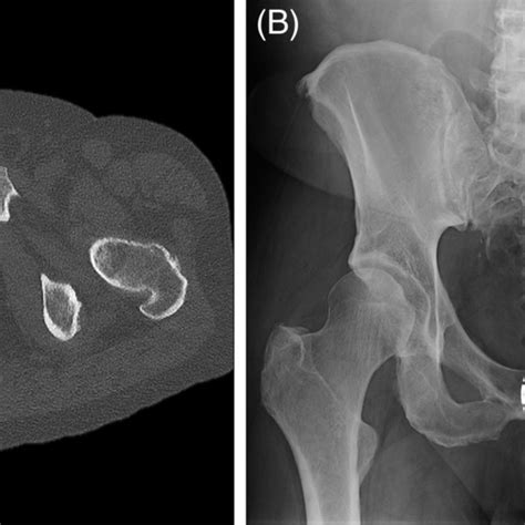 Aspecto Tomográfico Da Lesão Osteolítica No Nível De L5 Download