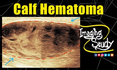 Case 96 Calf Hematoma Ultrasound Imaging Study