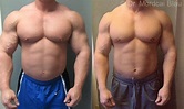 Professional Bodybuilders Gynecomastia Surgery - Before and After ...