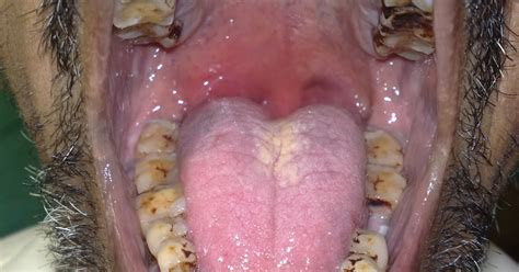 Peritonsillar Why Is Peritonsillar Abscess Called Quinsy