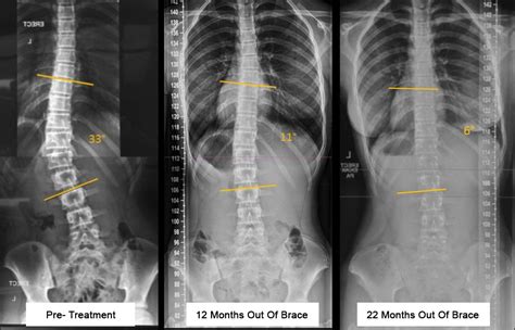 Scoliosis Nurse Assessment Brandon Orthopedics