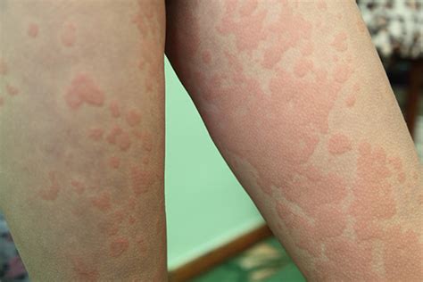 Hives Causes Symptoms And Treatments Nursa