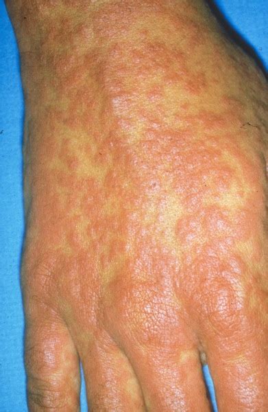 Health N Wealth Itchy Skin Bumps Skin Rashes Main Causes Symptoms