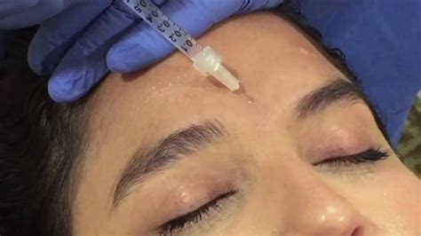 Botox Forehead Injections Youtube