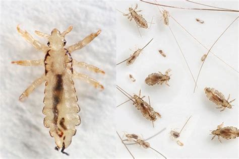 Head Lice Symptoms And Treatment Madeformums