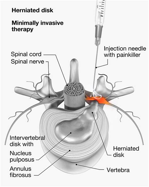 Nerve Root Injection Transforaminal Epidural Injection Bristol