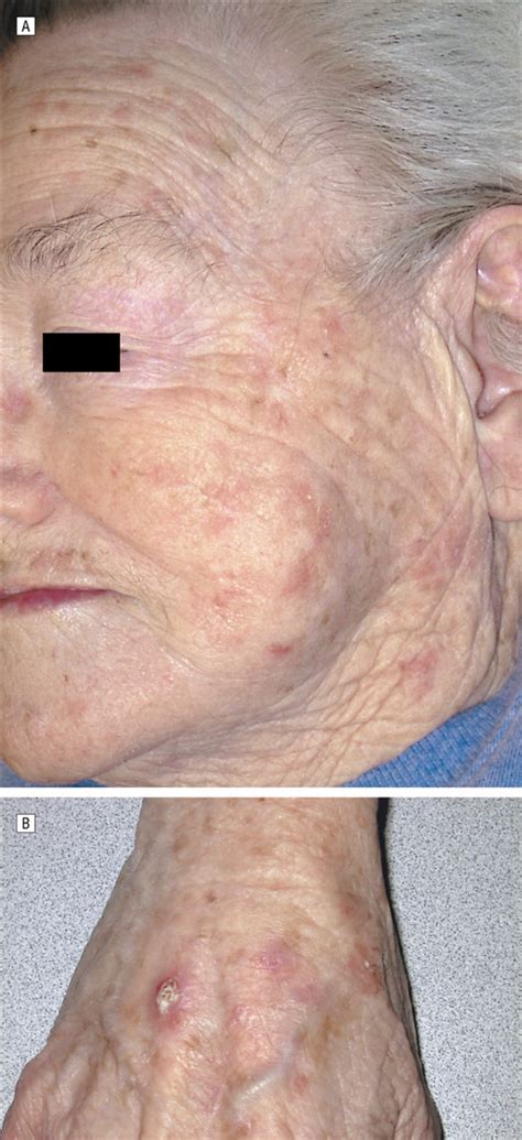 Inflammation Of Actinic Keratoses During Capecitabine Therapy