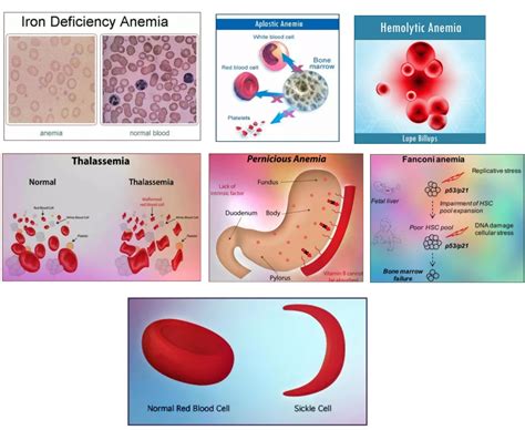Types Of Anemia Drugpharmamagazine Com