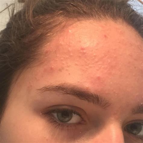 Hundreds Of Forehead Bumps I Can T Get Rue Of General Acne Discussion