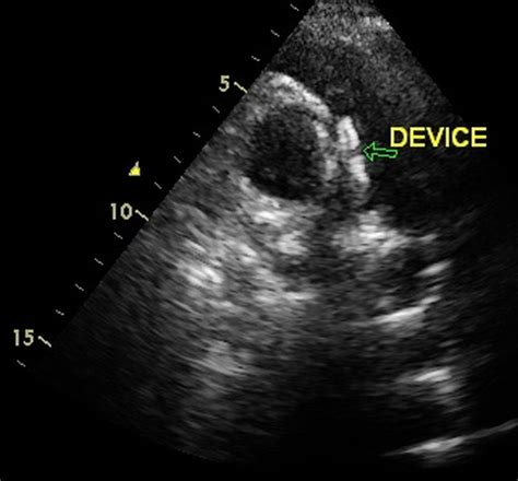 Echocardiogram Showing Device Closing Ap Window All About