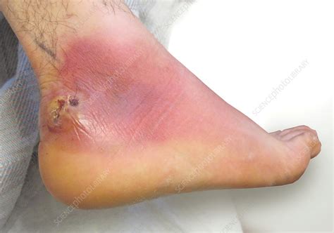 Foot Abscess Stock Image C0094809 Science Photo Library