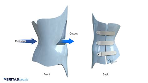 Types Of Scoliosis Braces Spine Health