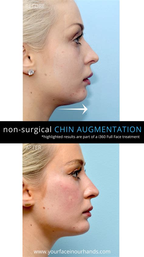 Before And After Results Of A Non Surgical Chin Augmentation With