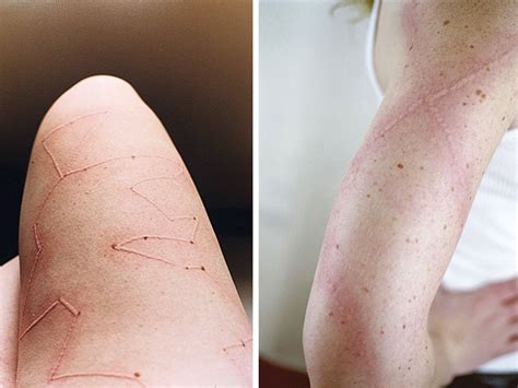 Artist Creates Body Designs With Her Sensitive Skin Disorder