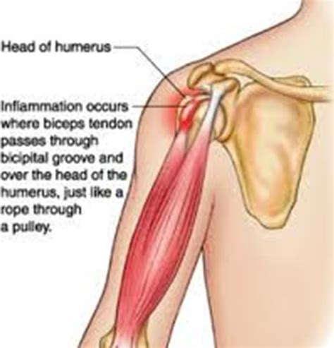 Biceps Tendinitis Brisbane Knee And Shoulder Clinic Dr Macgroartybrisbane Knee And Shoulder