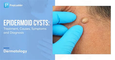Epidermoid Cysts Treatment Causes Symptoms And Diagnosis