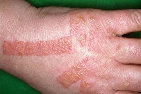 Top 115 Imagenes De Dermatitis En Las Manos Theplanetcomicsmx