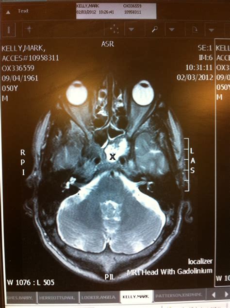 Mri Brain Scan Results White Spots