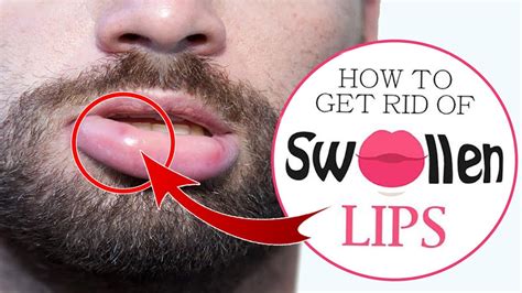 How To Treat Swollen Lips Naturally At Home Home Remedies For Swollen Lips Treatment Youtube