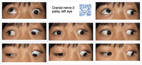Third Cranial Nerve Palsy