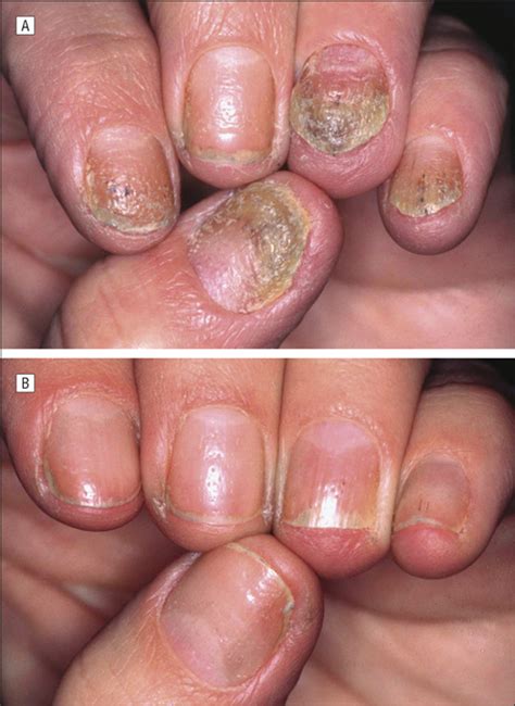 Evaluation Of The Efficacy Of Acitretin Therapy For Nail Psoriasis