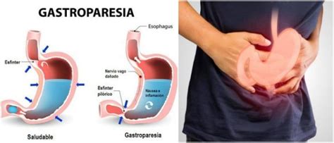 Gastroparesia ¿qué Es Causas Factores De Riesgo Síntomas