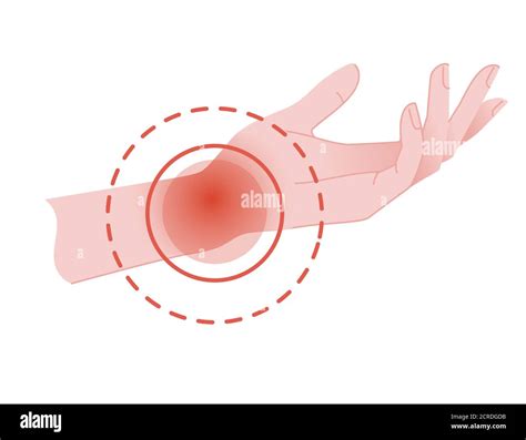 Human Wrist Pain With Red Pain Circle Flat Vector Illustration On White