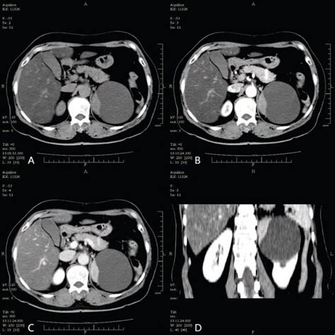Abdominal Ct Scans Of The Patient A Abdominal Plain Ct Scans Showing