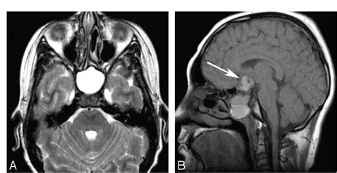 Figure 2 From Sphenoid Masses In Children Radiologic Differential