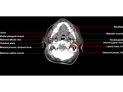 Axial Ct Neck Anatomy