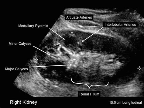 Kidney Anatomy Ultrasound