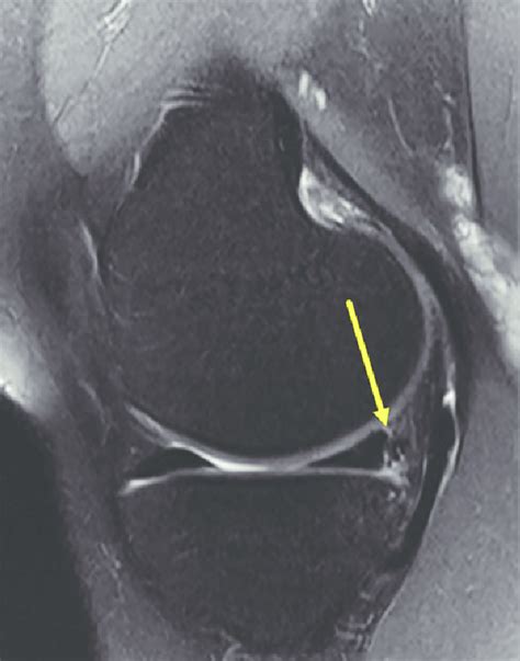 Sagittal T2 Magnetic Resonance Image Of The Medial Compartment Of A