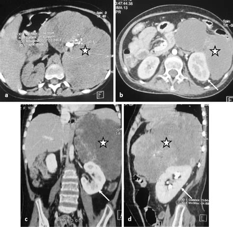 Abdominal Ct Scan Showing A Huge Tissue Mass Adrenal Left Multilobed