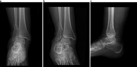 Ankle Fractures Musculoskeletal Key